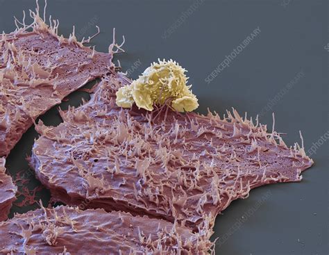 White Blood Cells Attacking Cancer Cells Sem Stock Image C0459620