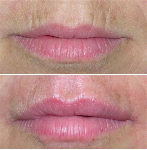 Lip Wrinkle Remedies Beauty Career Online Training