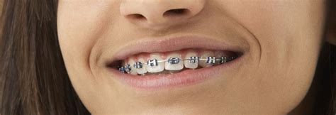 Best Orthodontist Near Me Affordable Orthodontic Treatment Cost