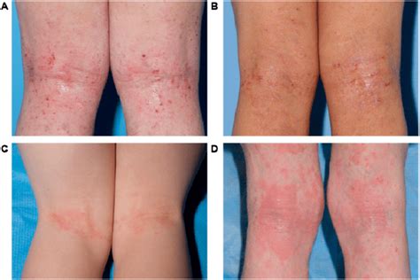 Is Atopic Dermatitis A Disease Atopic Dermatitis Symptoms