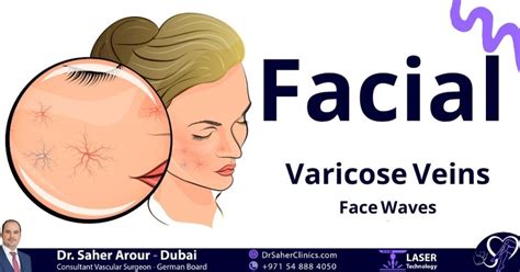 Face Waves Facial Varicose Veins 7 Varicose Veins Clinics Dubai