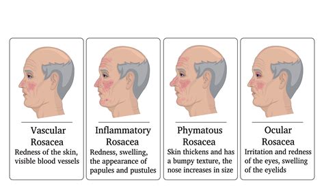 Rosacea Skin Treatment In Exeter And Torquay In Devon