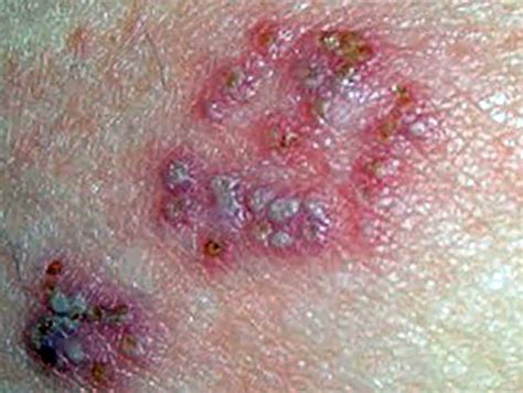 Herpes Simplex Virus 2 Hsv 2 Prevenzione Segni E Sintomi Cause E