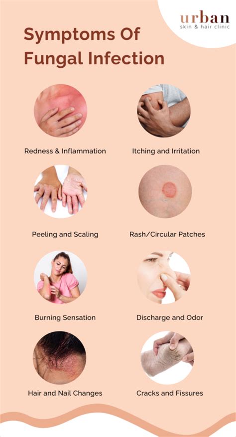 Fungal Infection Types Causes Symptoms And Treatment Ushc