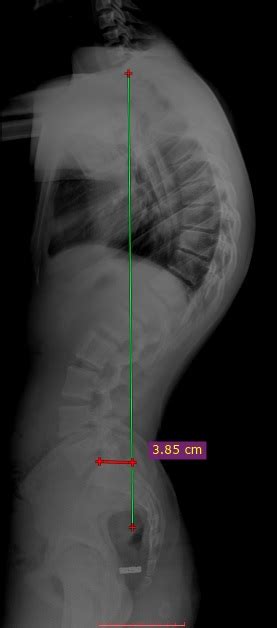 Scheuermanns Kyphosis Selcuk Medical Journal