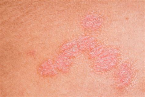Cutaneous And Intestinal Dysbiosis Cause Skin Inflammatory Diseases