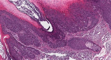 Squamous Cell Carcinoma In Situ Archives Atlas Of Pathology