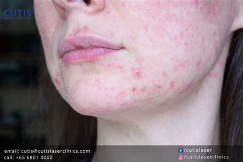 Treatments For Managing Rosacea Symptoms