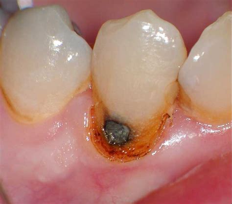 Neck Of Tooth Cavities