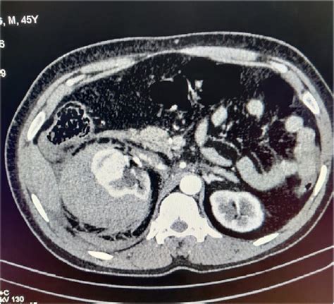 Contrast Ct Axial Cut Showing Right Sided Large Perinephric Hematoma