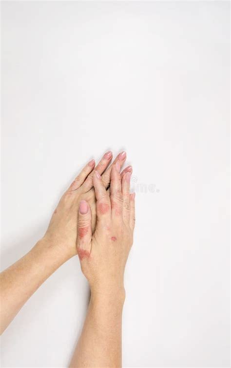 Eczema On The Hands Female Hands Affected By Dermatitis Close Up