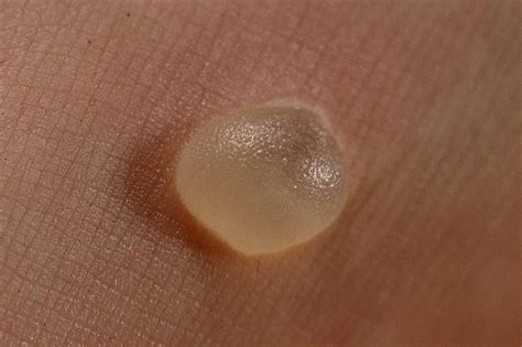 5 Simple Ways To Get Rid Of Blisters