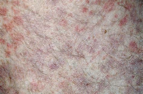 Allergic Purpura On The Skin Stock Image C0111679 Science Photo
