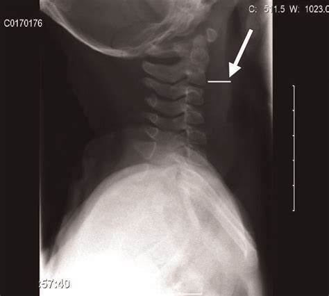 Plain Radiograph Lateral View Of The Neck Taken At Time Of Presentation