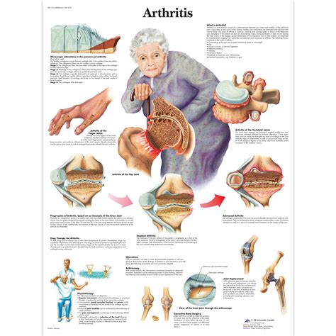 Anatomical Charts and Posters - Anatomy Charts - Geriatric Health Charts - Arthritis Laminated Chart