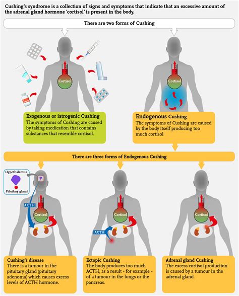 Cushings Syndrome Infographic Adrenalseu