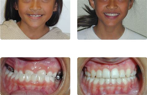 Orthodontic Before And After Photos Brodsky Orthodontics