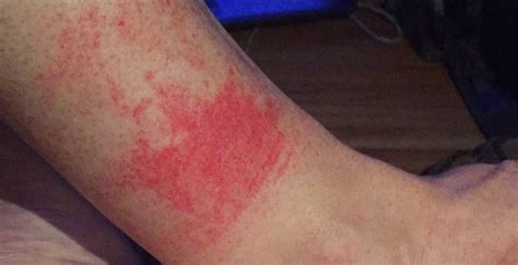 Disney Rash What It Is How To Treat It And How To Prevent It In The
