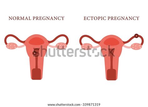 Ectopic Pregnancy Normal Pregnancy Concept Vector Stock Vector Royalty
