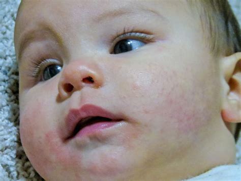 What Does Eczema Look Like On Toddlers What Does