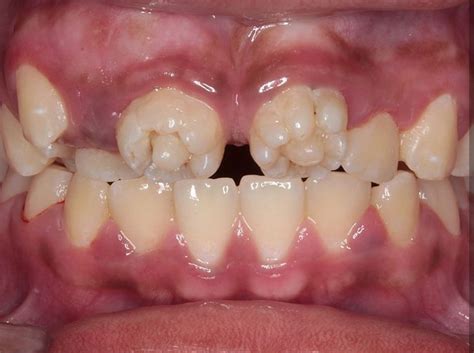 6 Year Old Molars Coming In Teethwalls