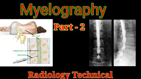 Myelography Procedure Part 2 Myelogram Examination By Bl