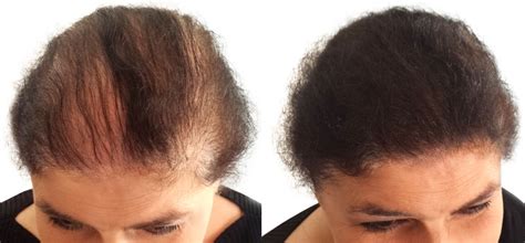 See How Easy It Is To Apply BOOSTnBLEND To Thinning Hair