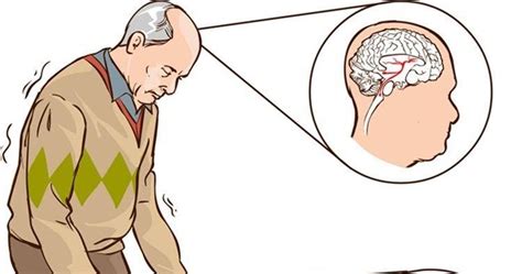 O Diagnóstico Clínico Da Doença De Parkinson