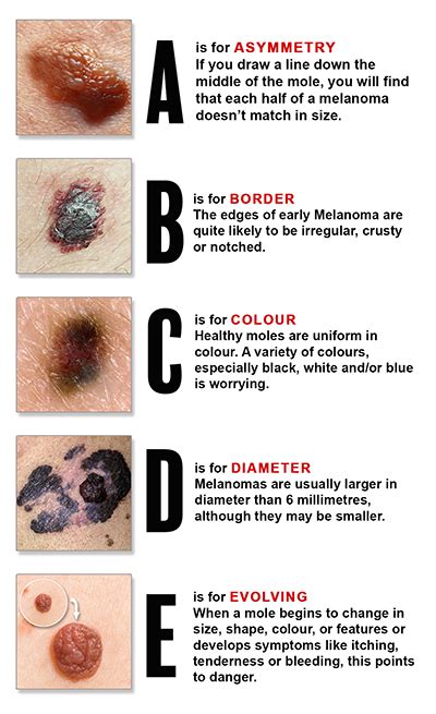 The Abcde Rule Of Skin Cancer Quality Dermatology Vrogue Co