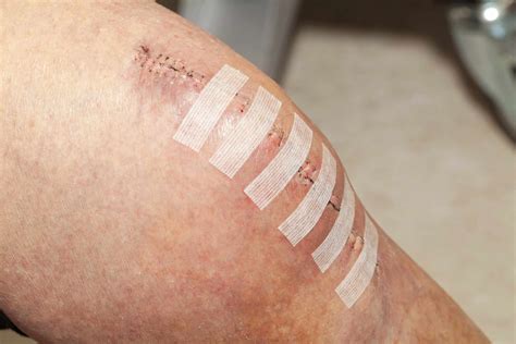 How To Care For A Surgical Wound Incision Care Made Easy