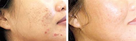 Scar Revision With Sciton Profractional® Laser In Medford Or Pure Medspa
