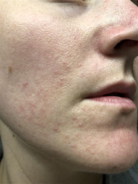 Skin Concern What Does This Look Like Perioral Dermatitis Acne