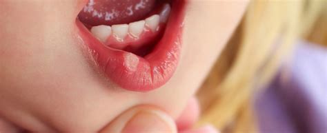Zapalenie jamy ustnej u dziecka przyczyny objawy leczenie Artykuł