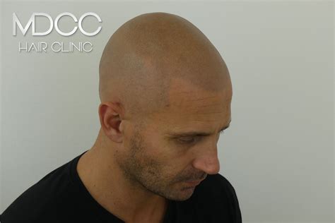 Greffe et implant cheveux à marseille - Micropigmentation Cheveux à