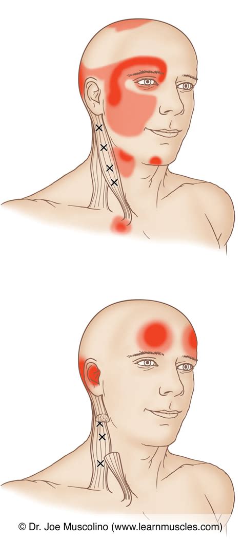 Sternocleidomastoid SCM Trigger Points Learn Muscles
