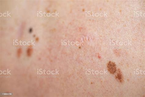 Melanocytic Nevus Some Of Them Dyplastic Or Atypical On A Caucasian Man