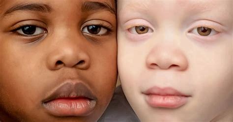 Twins With Different Skin Colors Astonished Their Mom When They Were Born Bright Side