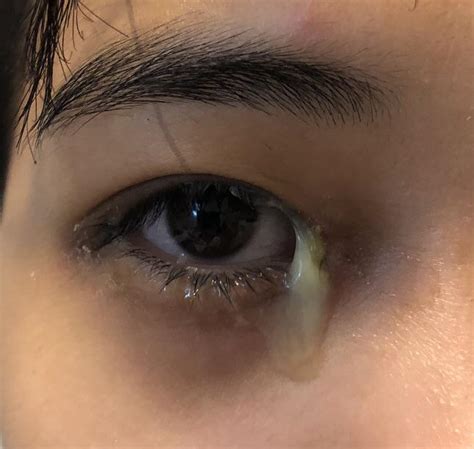 Too Much Build Up Of Mucus On My Right Eye Only Throughout The Day It