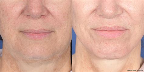 Lip Lift Before And After 10 Weber Facial Plastic Surgery