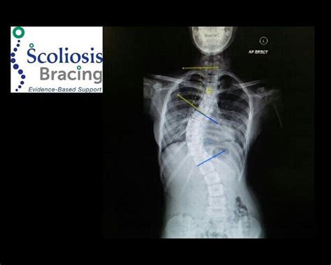 Scoliosis Facts Scoliosis Is An Abnormal Curve In The Spine There