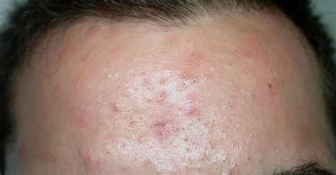 Acne Comedonica Causes And Treatment Of Comedonal Acne Exposed Skin