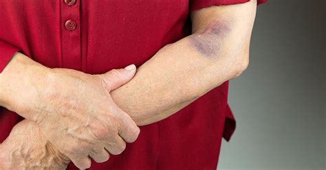 Rheumatoid Arthritis Bruising How To Care For A Bruise