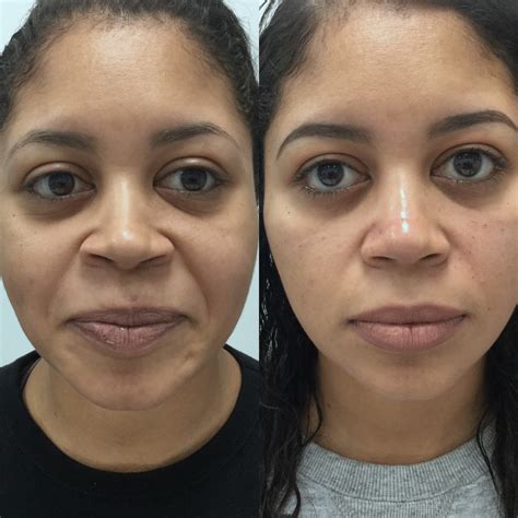 Before And Afters — Ideal Skin Medspa