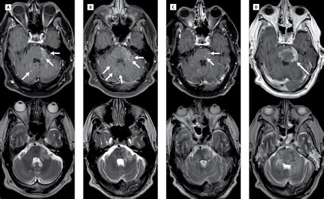 Clippers is a rare chronic inflammatory disorder of unknown cause that primarily affects the brainstem. Fatal B-cell Lymphoma Following CLIPPERS | Allergy and ...