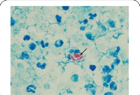 Slide From The Fine Needle Aspiration Of The Subcapsular Liver Abscess