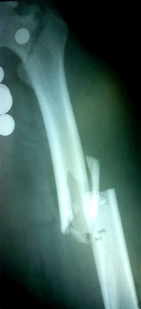 We did not find results for: O R T O C R I T I C A: Fractura Segmentaria de Femur en ...