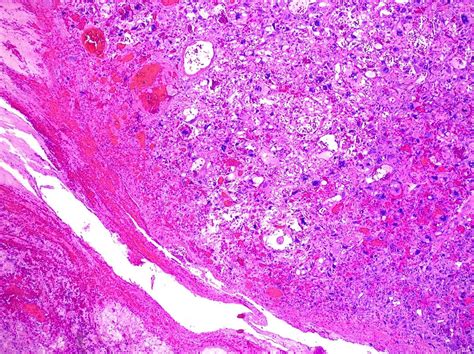 Pathology Outlines Pleomorphic Carcinoma
