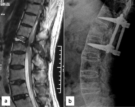 Andersson Lesion In Ankylosing Spondylitis Bmj Case Reports