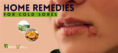 10 Simple And Best Home Remedies For Cold Sores