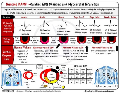 St Elevations Monitoring For Infarction Stemi Electrocardiogram Ecg Ekg